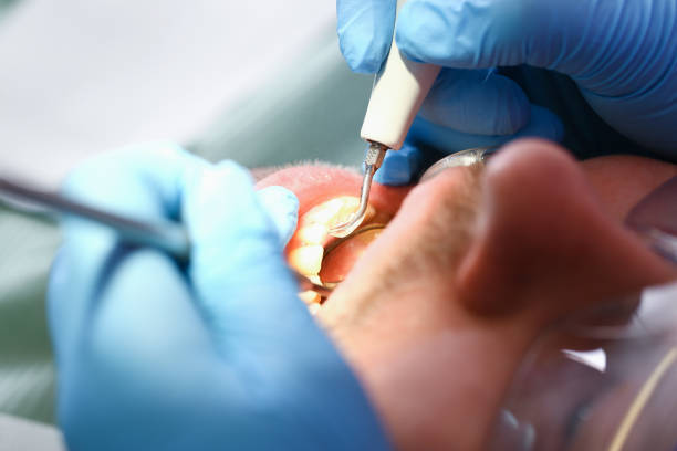 Best Emergency Tooth Extraction in Coralville, IA