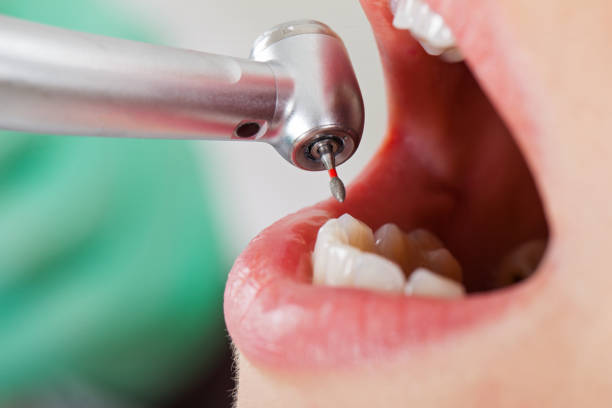 Best Emergency Root Canal Treatment in Coralville, IA
